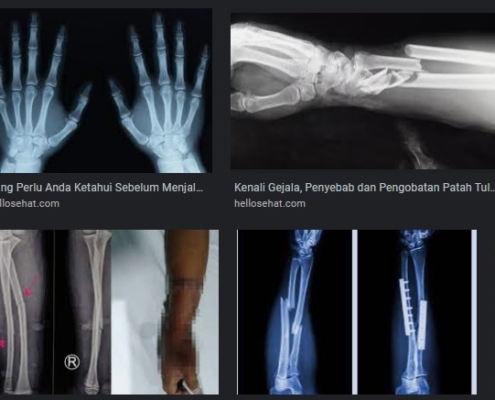 Biaya Rontgen Tulang Tangan