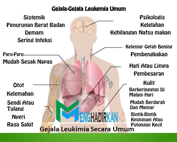 Gejala Leukimia Secara Umum
